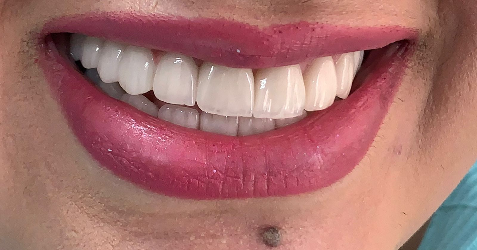 Veneer dental treatment after